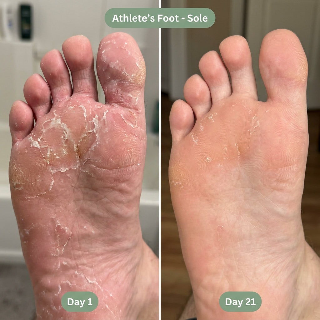 IronBark Tea Tree Antifungal Bar – Clears Athlete's Foot From the Root and Stops It Coming Back