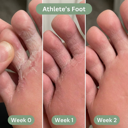 IronBark Tea Tree Antifungal Bar – Clears Athlete's Foot From the Root and Stops It Coming Back